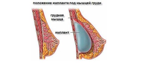 Маммопластика под мышцу. Грудные импланты под мышцу. Имплант под грудной мышцей. Грудные импланты под мышцу. Имплант под грудной мышцей.